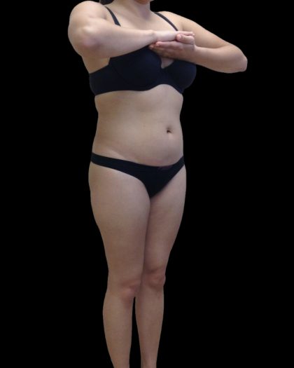 Liposuction Female Before & After Patient #2743