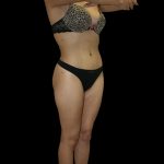 Liposuction Female Before & After Patient #2743
