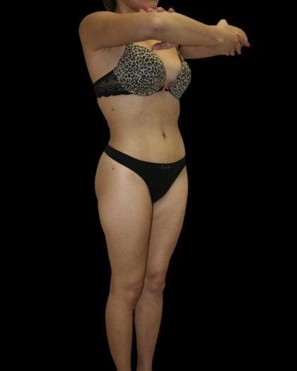 Liposuction Female Before & After Patient #2743