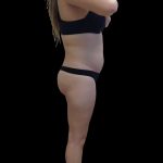 Liposuction Female Before & After Patient #2743