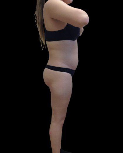 Liposuction Female Before & After Patient #2743