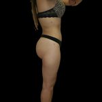 Liposuction Female Before & After Patient #2743