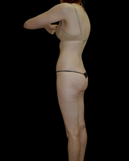 Liposuction Female Before & After Patient #2744