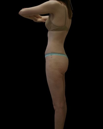 Liposuction Female Before & After Patient #2744