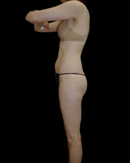 Liposuction Female Before & After Patient #2744