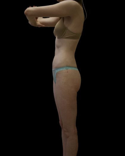 Liposuction Female Before & After Patient #2744