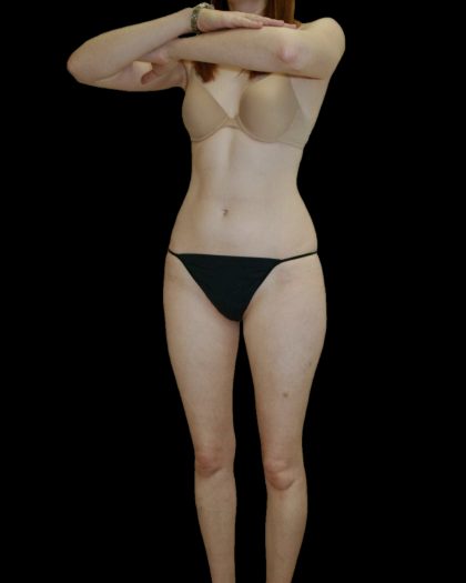 Liposuction Female Before & After Patient #2744