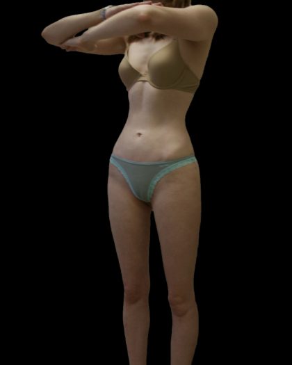 Liposuction Female Before & After Patient #2744