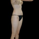 Liposuction Female Before & After Patient #2744