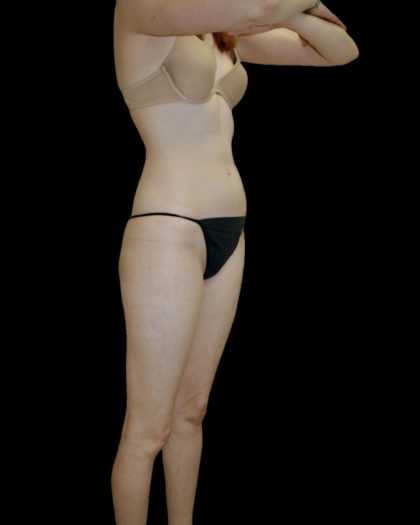 Liposuction Female Before & After Patient #2744