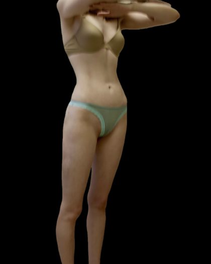 Liposuction Female Before & After Patient #2744