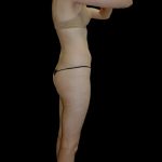 Liposuction Female Before & After Patient #2744