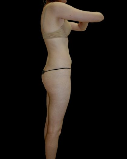 Liposuction Female Before & After Patient #2744