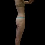 Liposuction Female Before & After Patient #2744