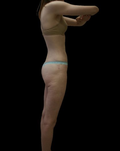 Liposuction Female Before & After Patient #2744