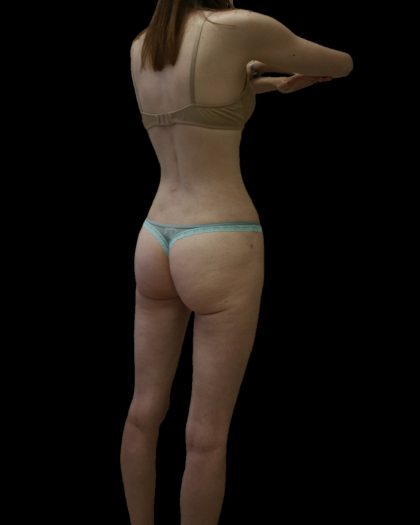 Liposuction Female Before & After Patient #2744