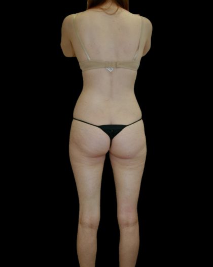 Liposuction Female Before & After Patient #2744