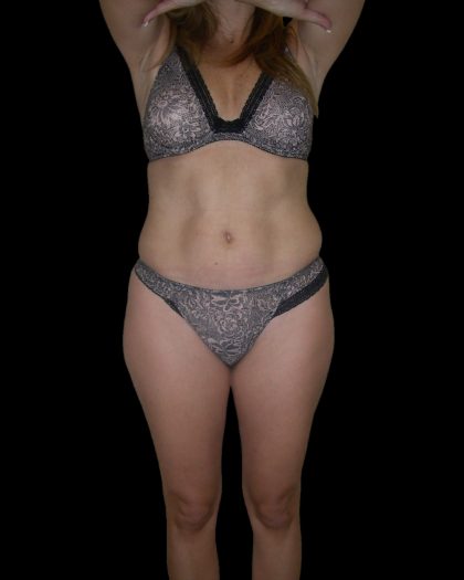 Liposuction Female Before & After Patient #2745
