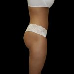 Liposuction Female Before & After Patient #2746
