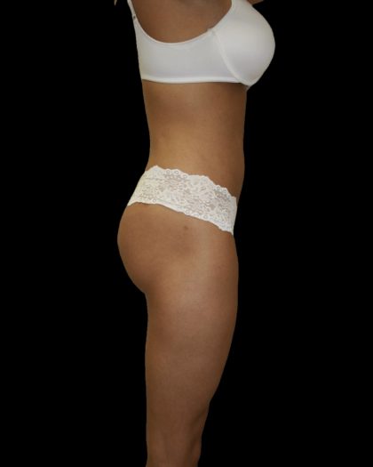 Liposuction Female Before & After Patient #2746