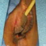Vaginoplasty Before & After Patient #2831