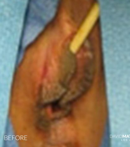 Vaginoplasty Before & After Patient #2831