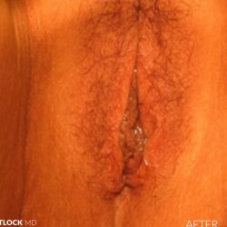 Vaginoplasty Before & After Patient #2831