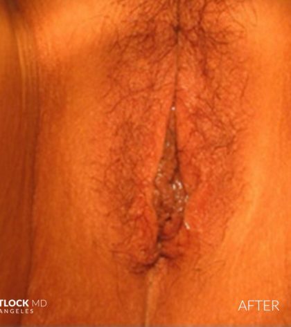 Vaginoplasty Before & After Patient #2831