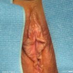 Vaginoplasty Before & After Patient #2834