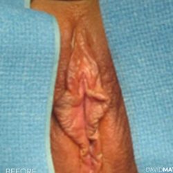 Vaginoplasty Before & After Patient #2834