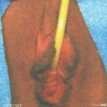 Vaginoplasty Before & After Patient #2835