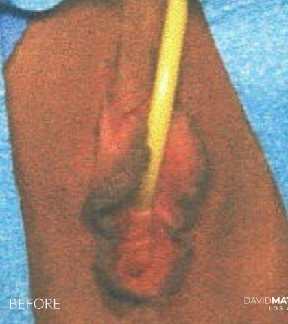 Vaginoplasty Before & After Patient #2835