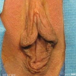 Vaginoplasty Before & After Patient #2836