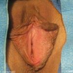 Vaginoplasty Before & After Patient #2839