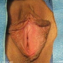 Vaginoplasty Before & After Patient #2839