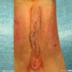 Vaginoplasty Before & After Patient #2821