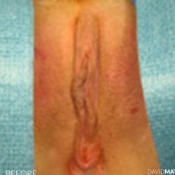 Vaginoplasty Before & After Patient #2821