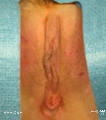 Vaginoplasty Before & After Patient #2821