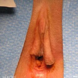 Vaginoplasty Before & After Patient #2822
