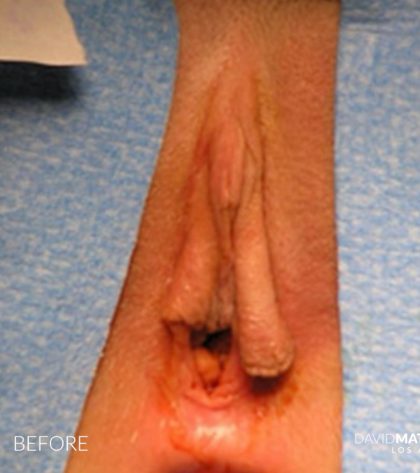 Vaginoplasty Before & After Patient #2822