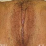 Vaginoplasty Before & After Patient #2825