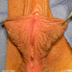 Vaginoplasty Before & After Patient #2826