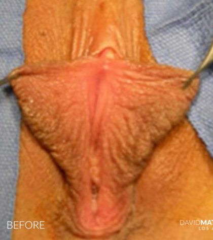 Vaginoplasty Before & After Patient #2826