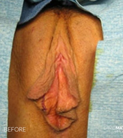 Vaginoplasty Before & After Patient #2827