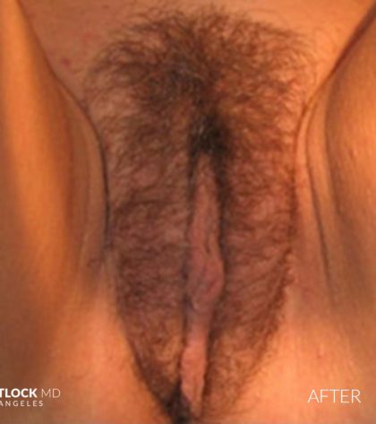 Vaginoplasty Before & After Patient #2827