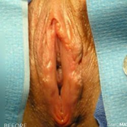 Vaginoplasty Before & After Patient #2829